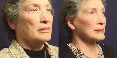 Facelift before and after photo