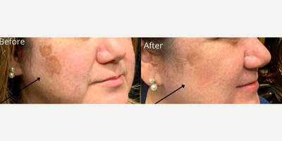 IPL before and after photo