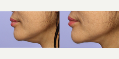 Neck Lift before and after photo