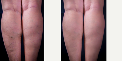 Sclerotherapy before and after photo