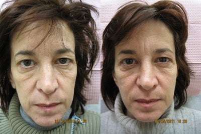 Sculptra before and after photo