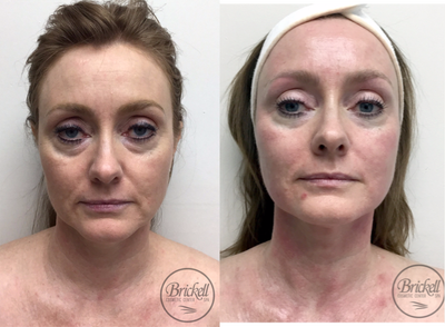 Skin Tightening before and after photo