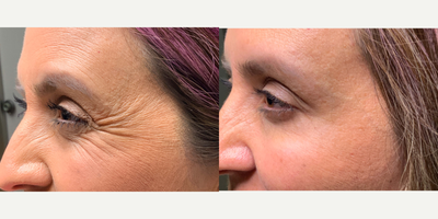 Botox before and after photo
