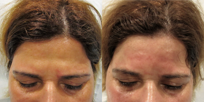 Dermal Fillers before and after photo
