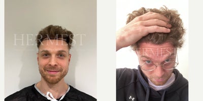 DHI Hair Transplant before and after photo