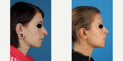 Rhinoplasty before and after photo