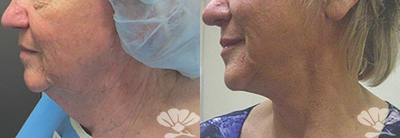 Thread Lift before and after photo
