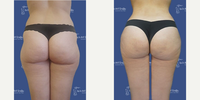 Vaser Liposuction before and after photo