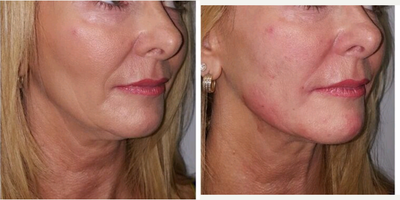 Bellafill before and after photo