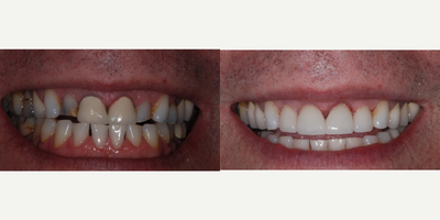 Dental Crown before and after photo