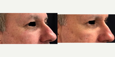 Skin Rejuvenation before and after photo
