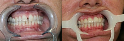 Dental Crown before and after photo
