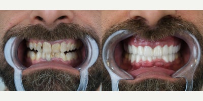 Dental Crown before and after photo