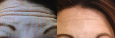Dysport before and after photo