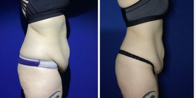 Emsculpt before and after photo