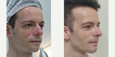 IPL before and after photo