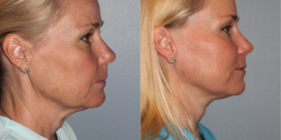 Lower Facelift before and after photo