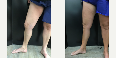 Sclerotherapy before and after photo