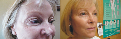 Dermal Fillers before and after photo