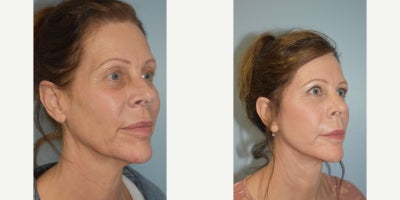 Facial Fat Transfer before and after photo