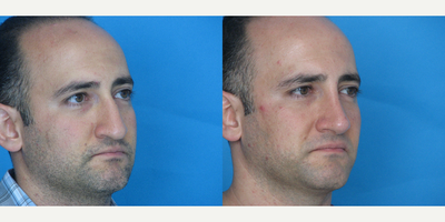 Rhinoplasty before and after photo