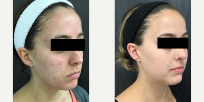 Accutane before and after photo