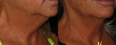 Microneedling RF before and after photo