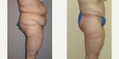 Body Lift before and after photo