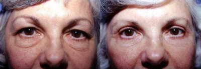 Eyelid Surgery before and after photo