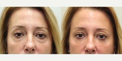 Eyelid Surgery before and after photo