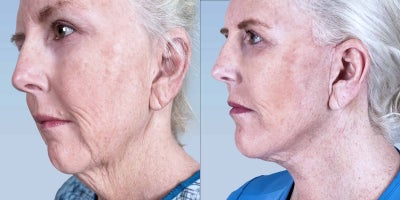 Mini Facelift before and after photo