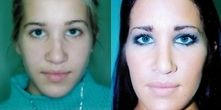 Rhinoplasty before and after photo