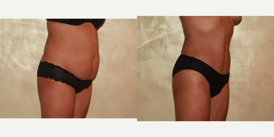 Tummy Tuck before and after photo