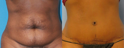 Tummy Tuck before and after photo