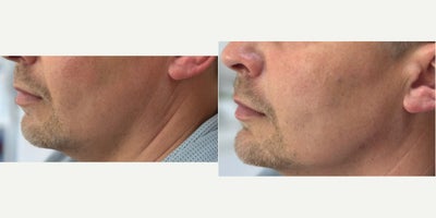 Chin Filler before and after photo