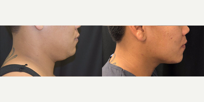 CoolMini before and after photo