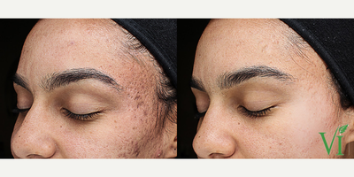 Facial before and after photo