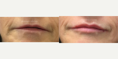 Juvederm before and after photo