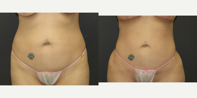 Liposuction before and after photo