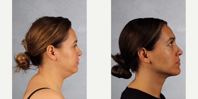 Liposuction before and after photo