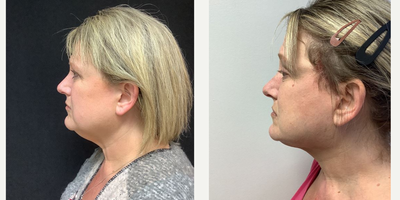 before and after image