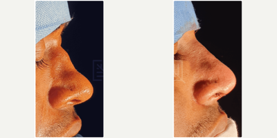 Rhinoplasty before and after photo