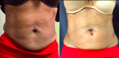 SculpSure before and after photo