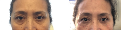 Dermal Fillers before and after photo
