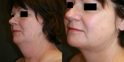 Facelift before and after photo