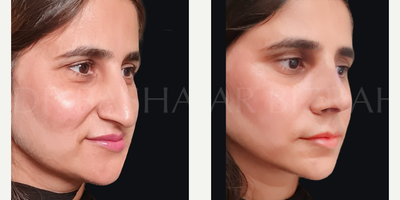 Facelift before and after photo