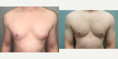 Gynecomastia Surgery before and after photo