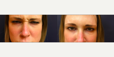 Botox before and after photo