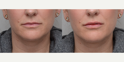 Dermal Fillers before and after photo