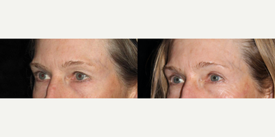 Eyelid Surgery before and after photo